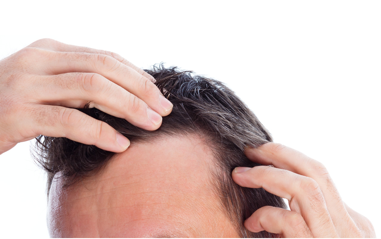 alopecia clínica DAS