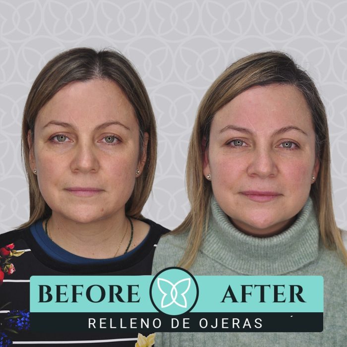 Clínica Dra. Ariana Sánchez Relleno de Ojeras