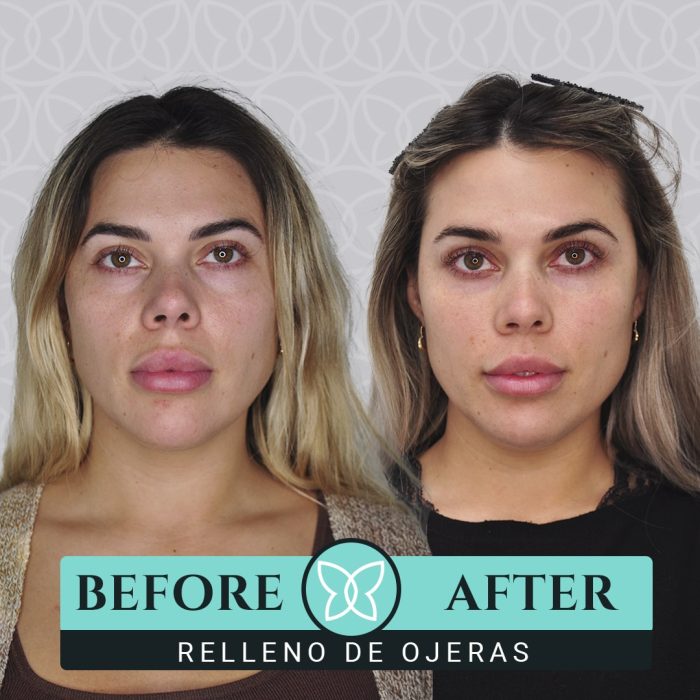 Clínica Dra. Ariana Sánchez Relleno de Ojeras
