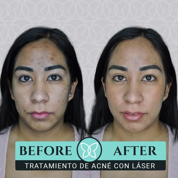 tratamiento de cicatrices de acné