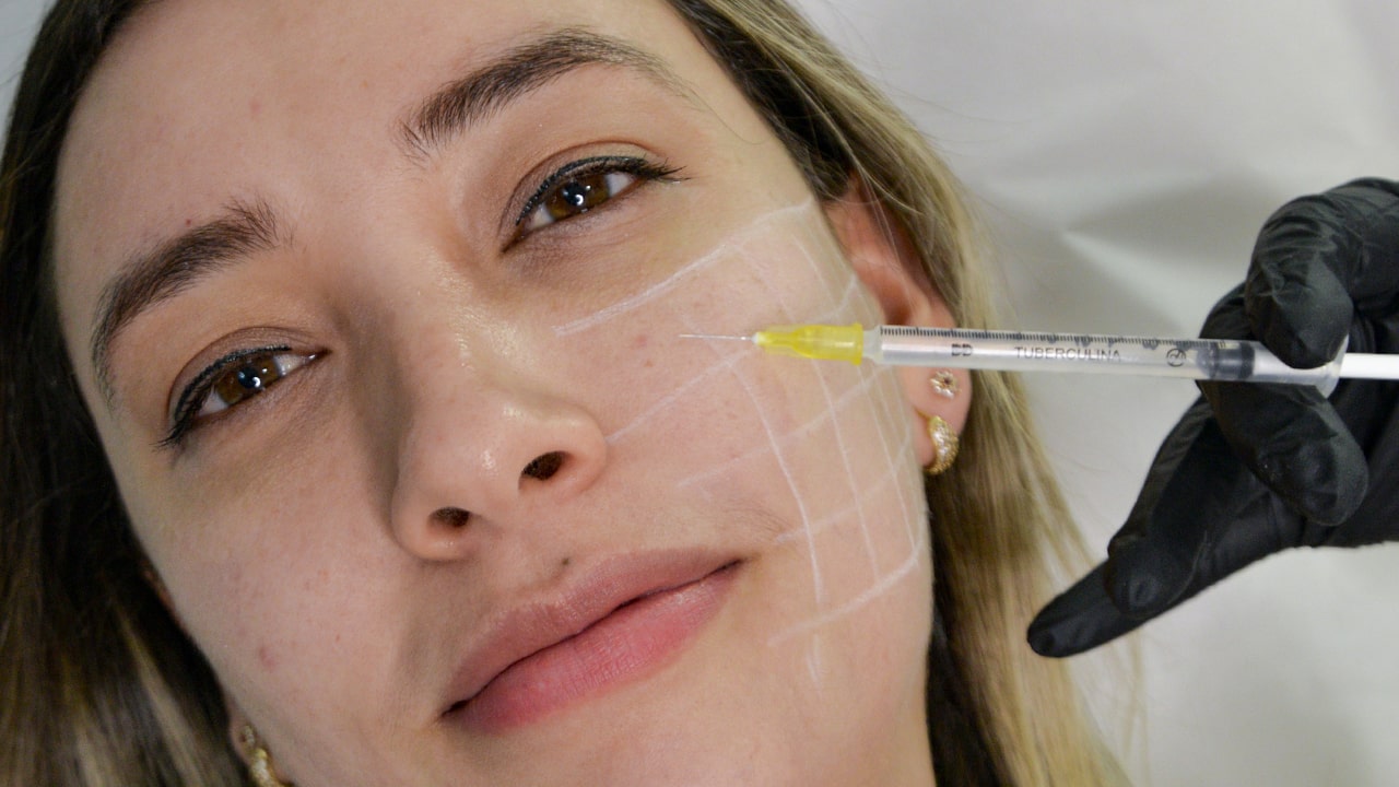 Mesobotox Para Rosácea Y Acné Clínica Dra Ariana Sánchez 8673