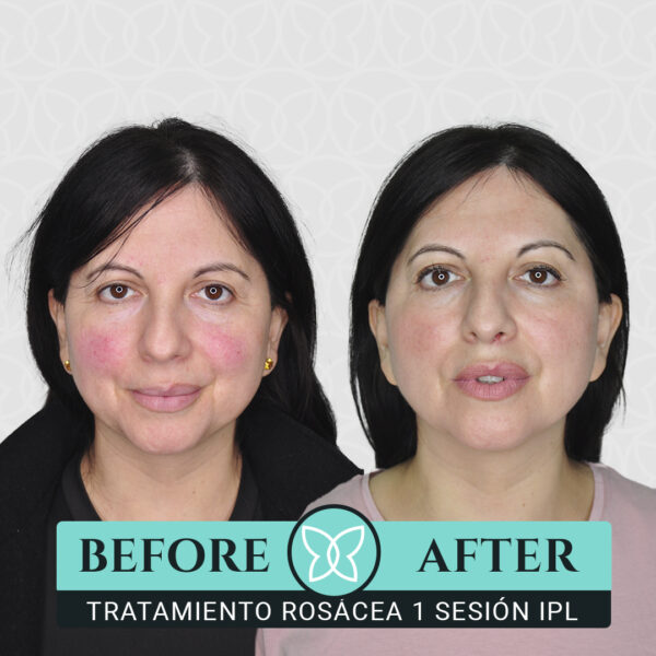 Pack de 3 Sesiones para Rósacea con Láser Nordlys - Imagen 4