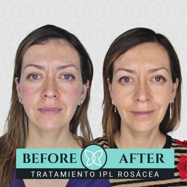 Pack de 3 Sesiones para Rósacea con Láser Nordlys - Imagen 3