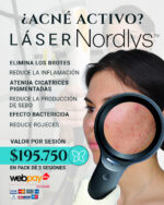 Tratamiento de acné activo con láser nordlys