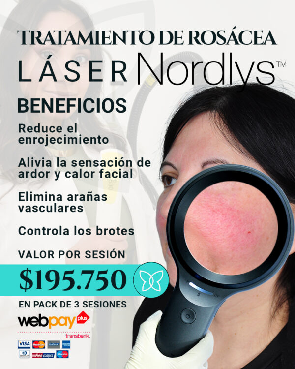 Tratamiento de rosácea con láser Nordlys