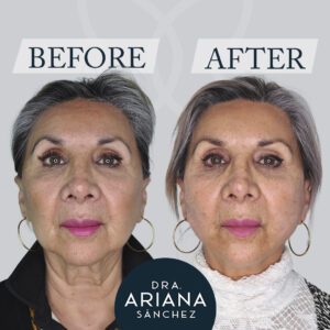 hilos tensores antes y despues