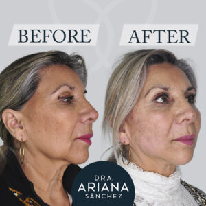 hilos tensores antes y despues
