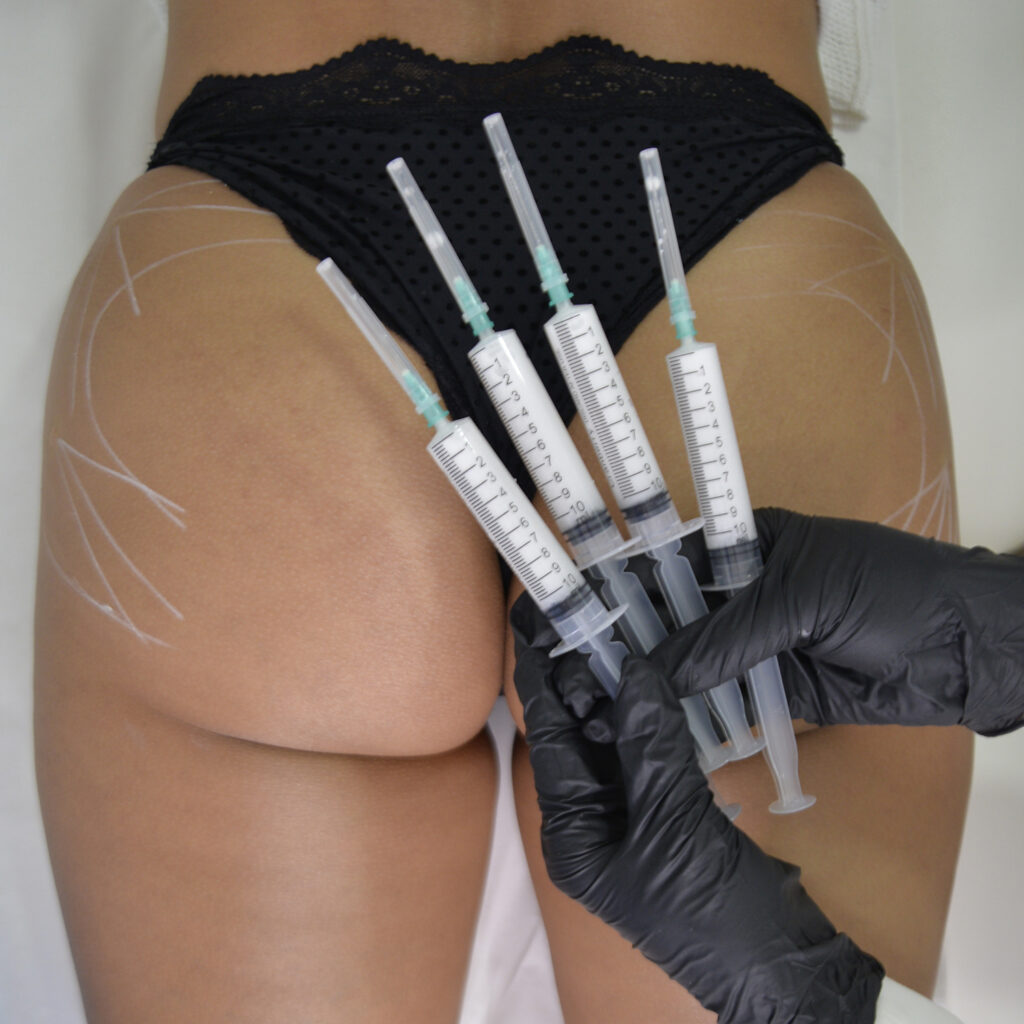 Aumento de Gluteos Natural