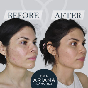 acne activo
