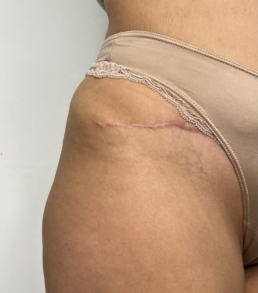 Cicatriz por Abdominoplastia