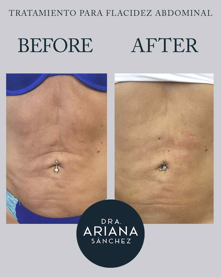 Flacidez Abdominal