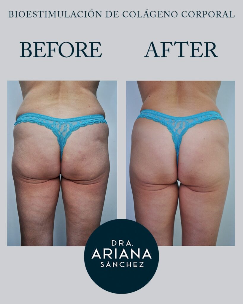 Aumento de Glúteos Natural con bioestimuladores de colágeno