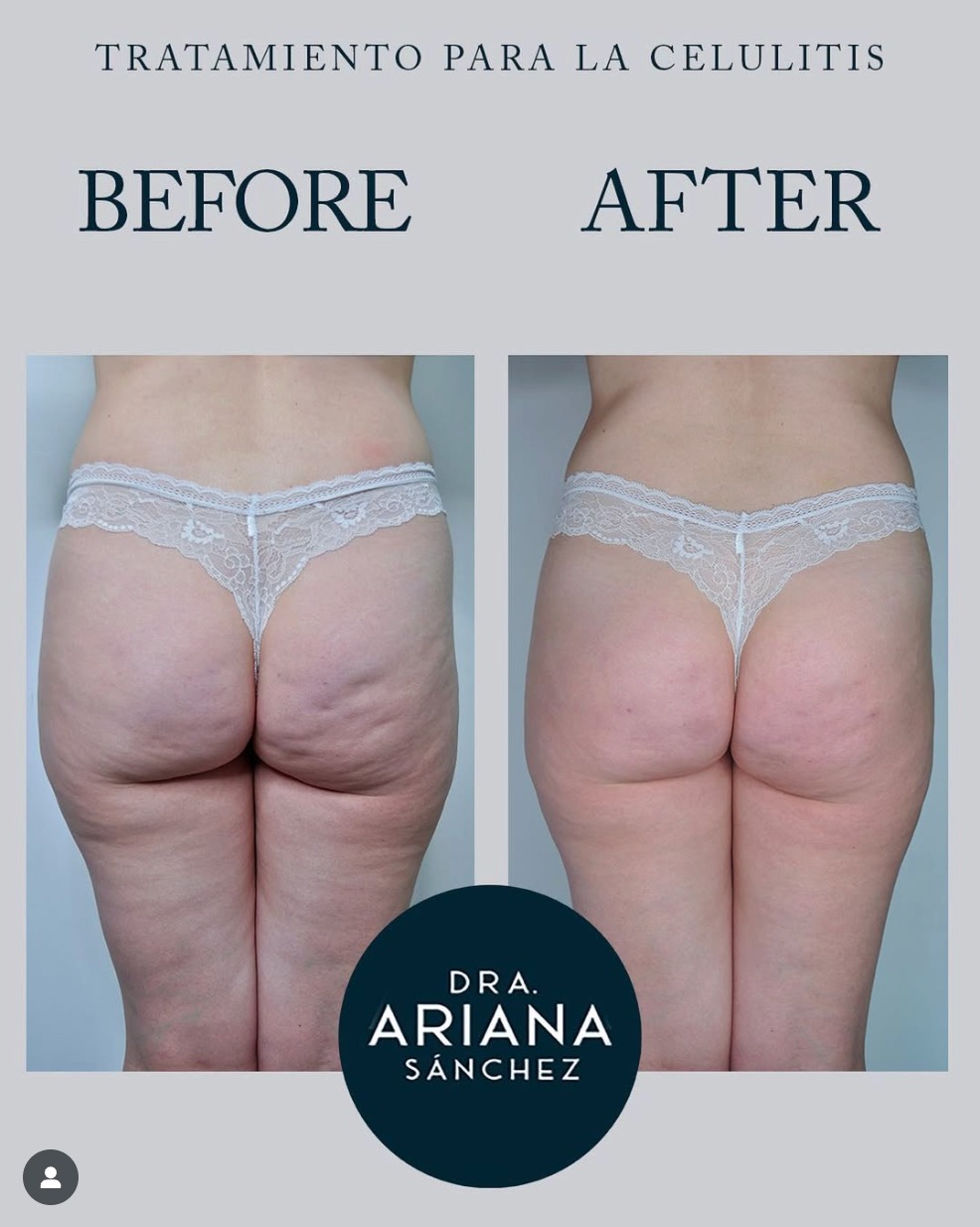 Aumento de Glúteos Natural con bioestimuladores de colágeno