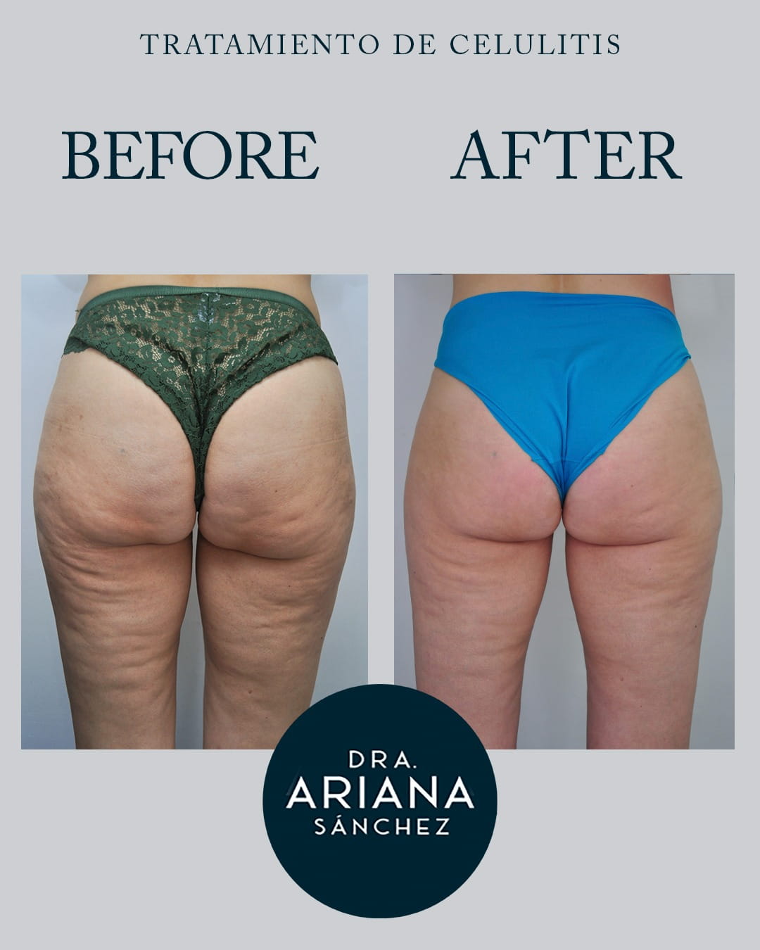 Aumento de Glúteos Natural con bioestimuladores de colágeno